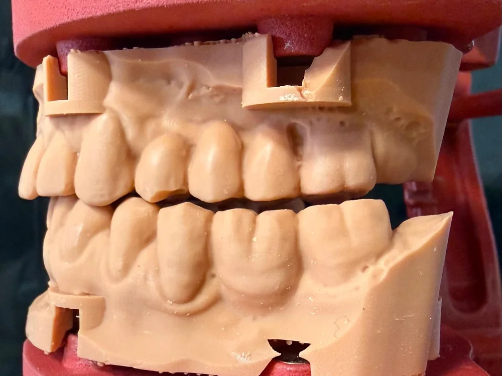 Gli stessi modelli stampati, sulle piastre DACOS nell'articolatore